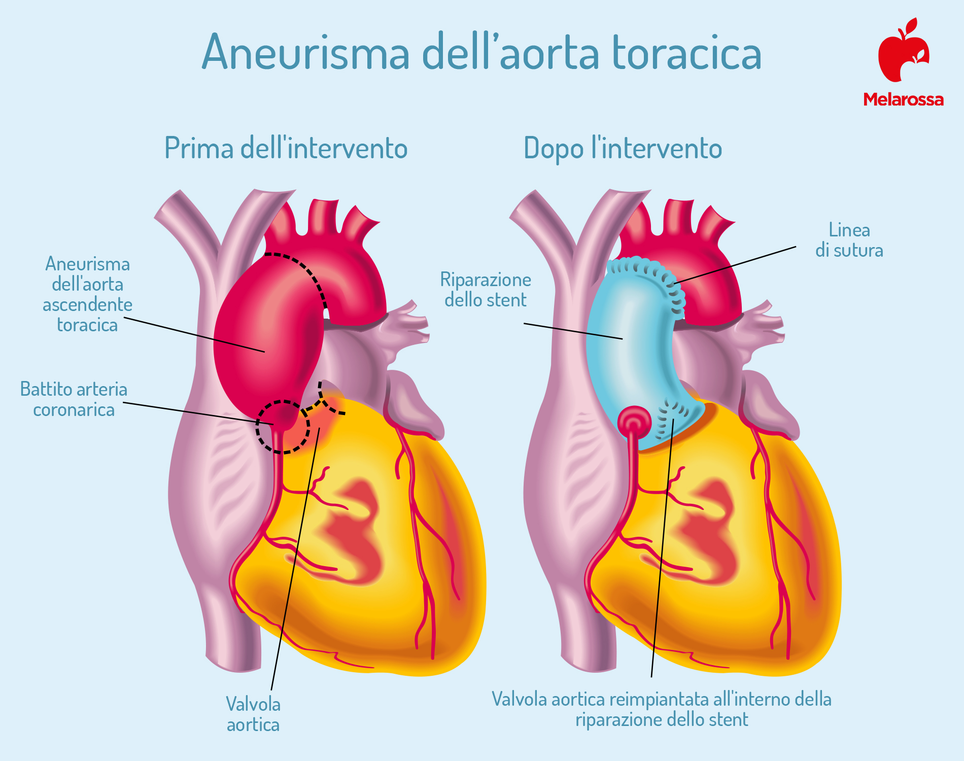 aneurisma de la aorta abdominal antes y después de la cirugía
